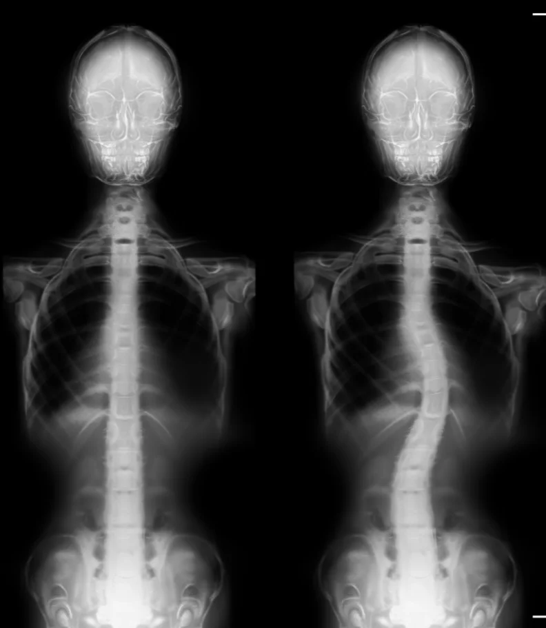 Scoliosis North Liberty